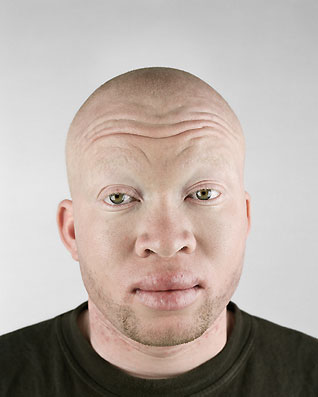 black albino kid